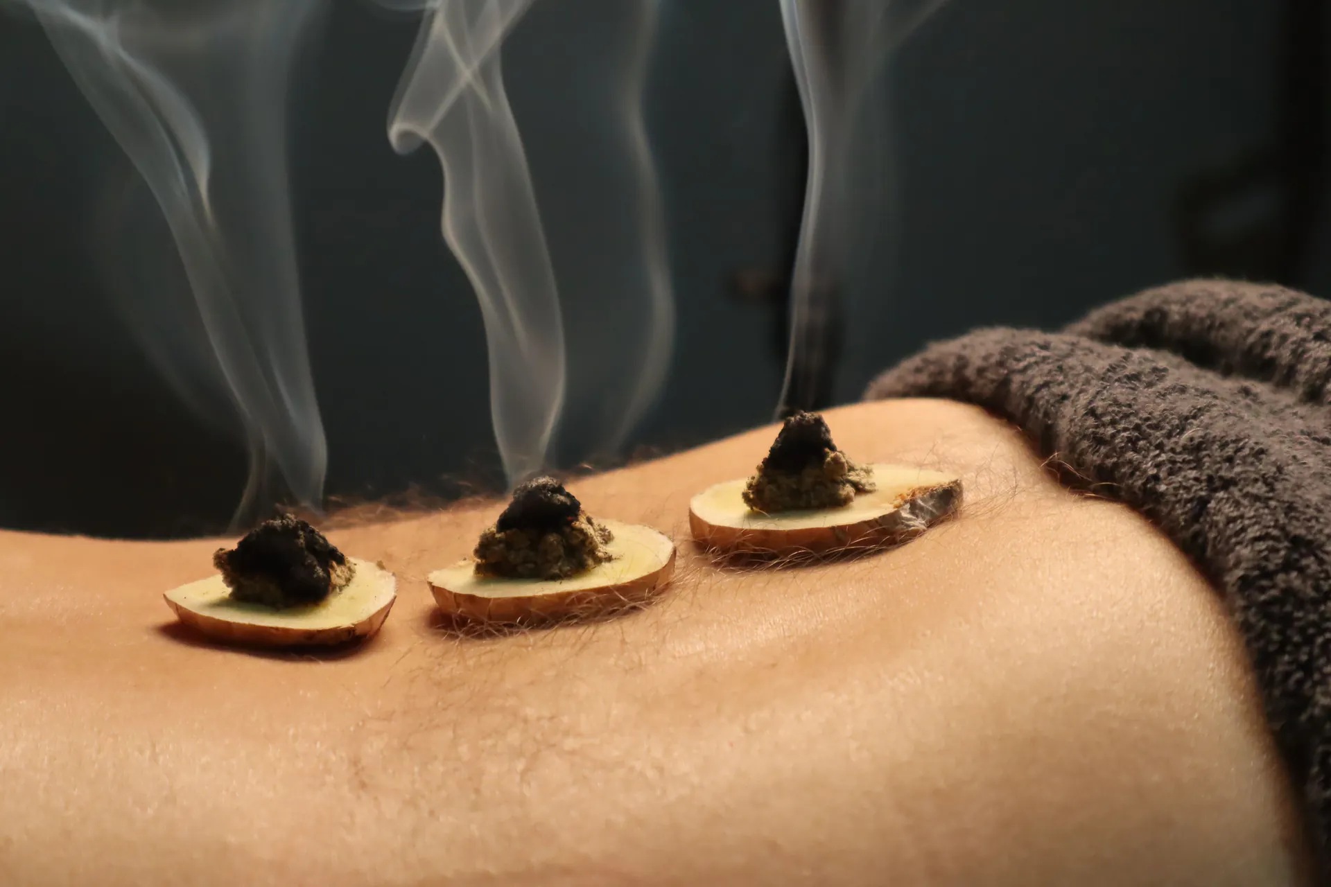 Herbal moxibustion cones smoking on a person’s back during therapy